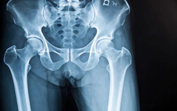 Schadensersatz abgebrochener Bohrer Hüftoperation