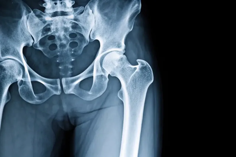 Behandlungsfehler bei Hüftoperation Knochen weggefräst Behandlungsfehler bei Hüftoperation Knochen weggefräst
