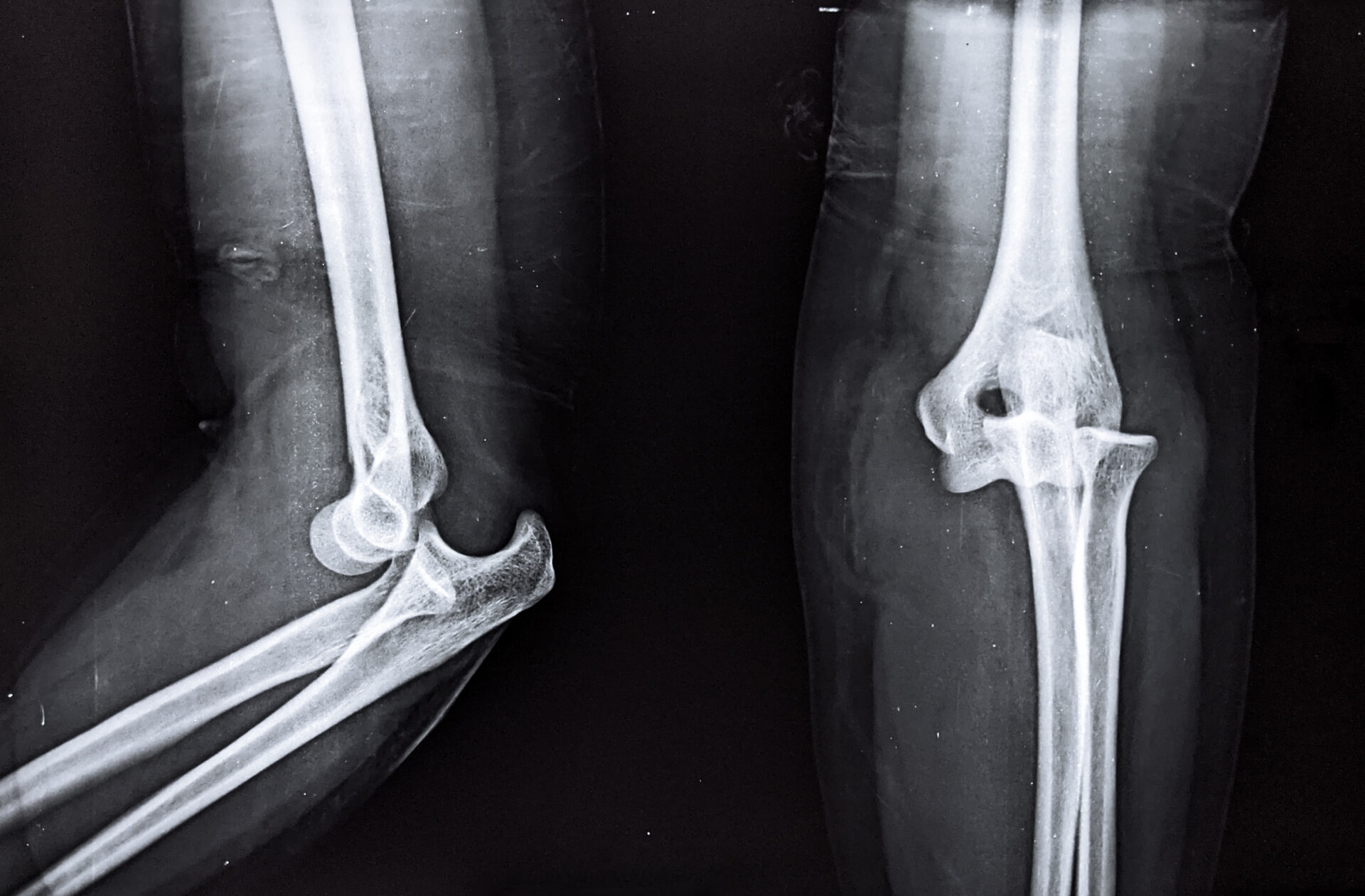 Gehörverlust Behandlungsfehler Medizinrecht Ellenbogen-OP Behandlungsfehler Medizinrecht